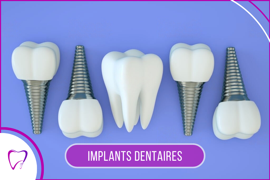 Implant Dentaire Lyon Dr Miguel Asin Dentiste Lyon